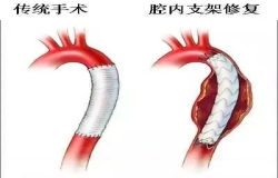 《問(wèn)心》熱播！全網(wǎng)熱議的主動(dòng)脈夾層，您了解嗎？
