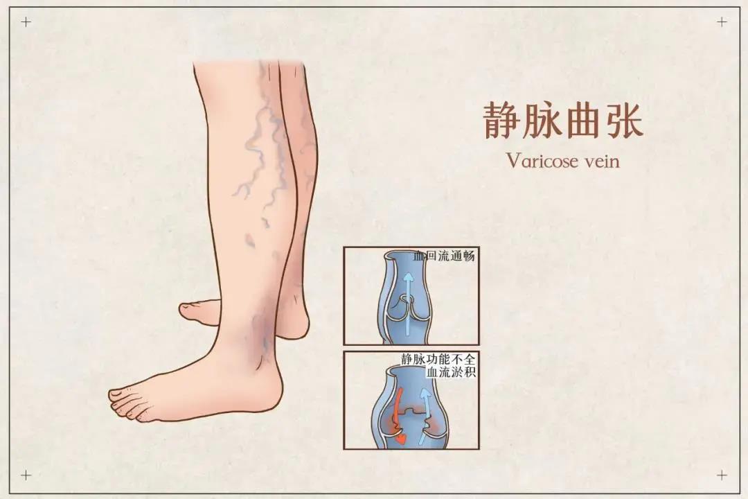 爬上腿的“蚯蚓”：靜脈曲張了怎么辦？