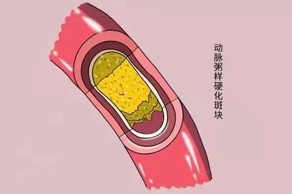 他汀類藥物有什么副作用？聽專家說......
